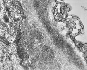 type III membranoproliferative glomerulonephritis